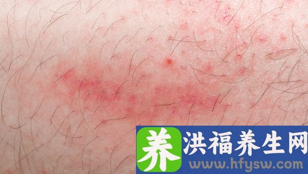 艾滋病初期小红点照片 艾滋病初期舌头会有症状吗？