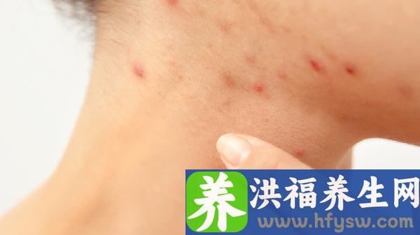 阴毛附近出水泡是疱疹吗