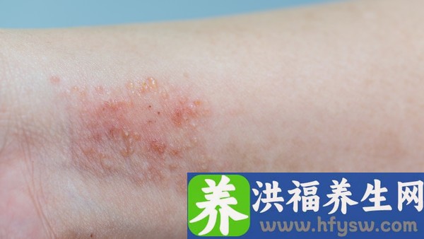 郁金银屑片治疗银屑病效果怎么样 郁金银屑片是抗病毒的药吗