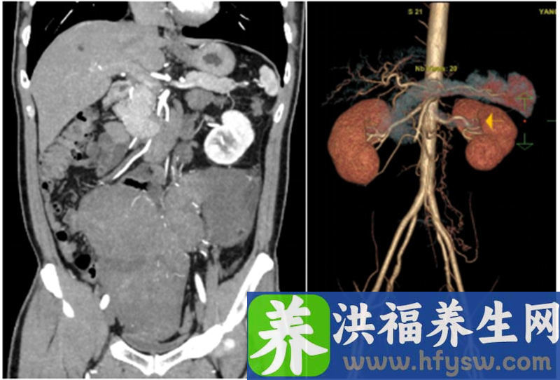 南方医院多学科联合借助混合现实视觉系统切除巨大肉瘤