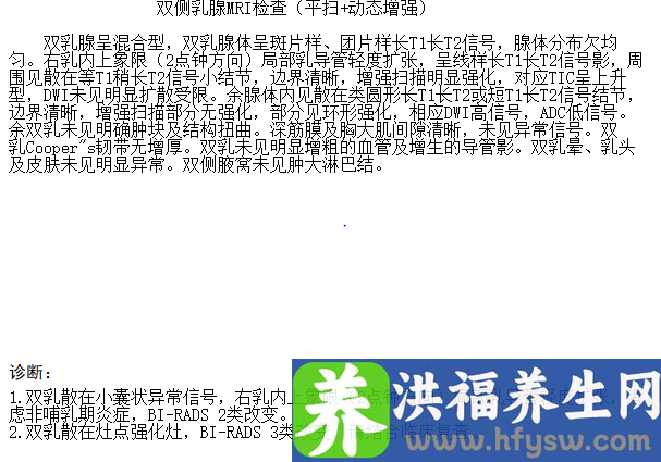 无诱因乳头溢血竟是乳腺导管内乳头状瘤惹的祸