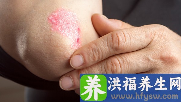 银屑灵颗粒是抗病毒的药吗 牛皮癣吃维生素b12有帮助吗