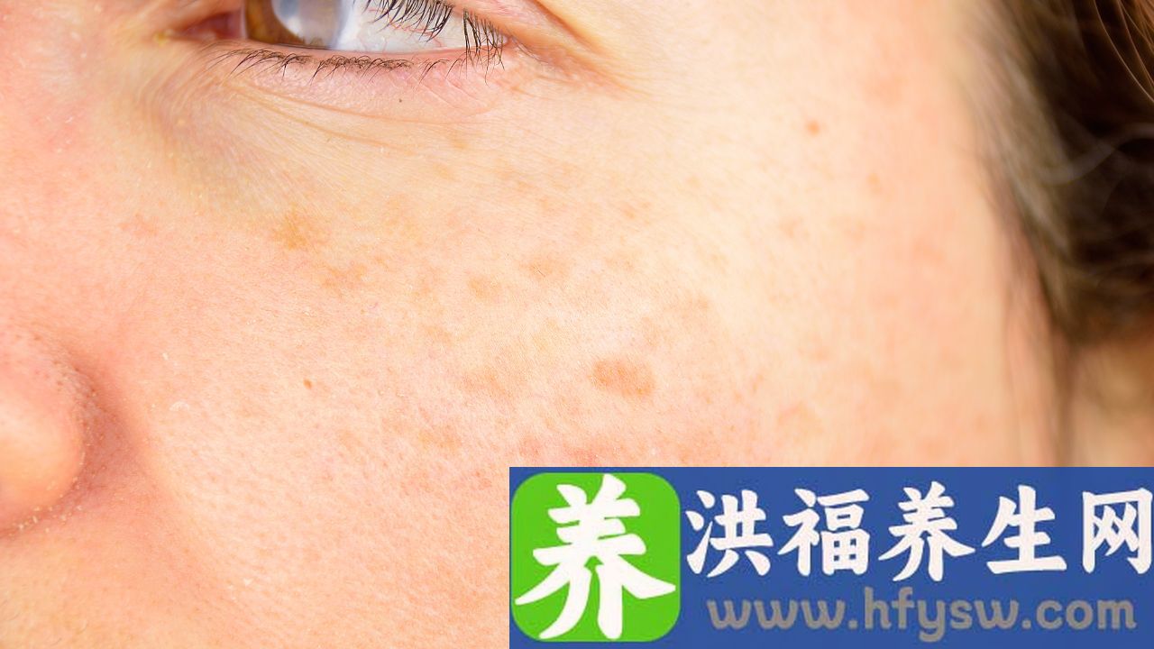 系统性红斑狼疮长红斑怎么办
