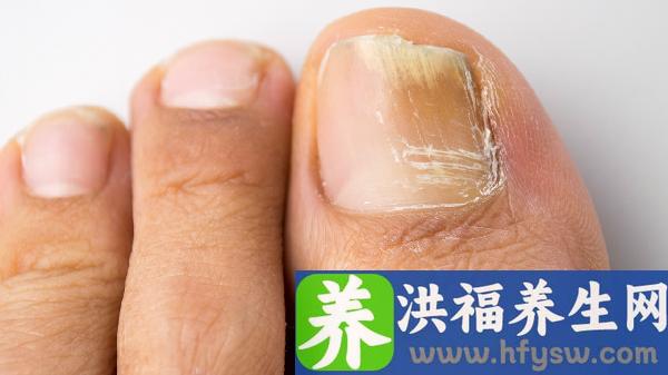 手指上甲沟炎红肿疼痛怎么缓解疼痛