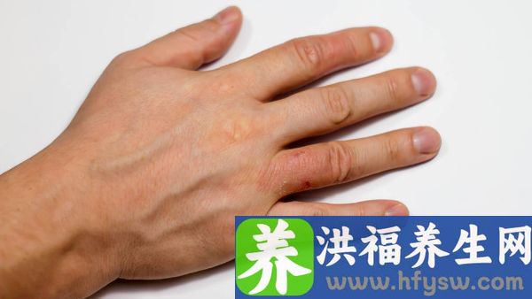 手指出现关节痛怎么办