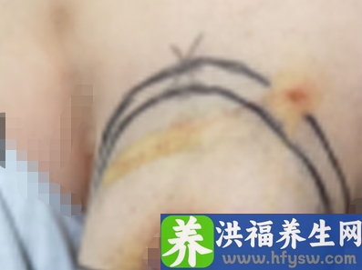 导管原位癌女性患者切除乳房，乳房重建填补缺憾