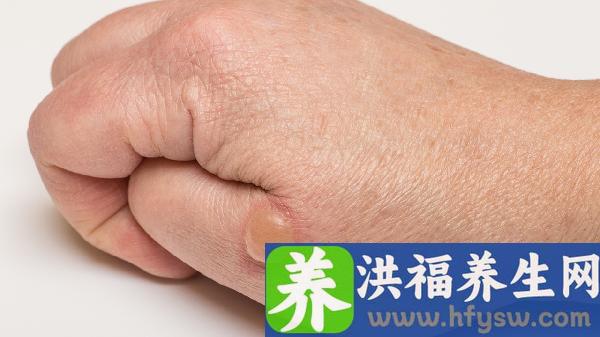 嘴唇起疱疹能涂牙膏吗