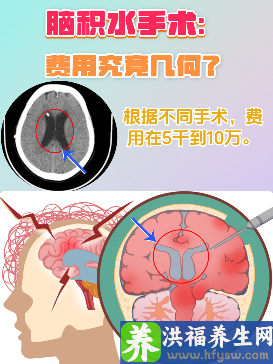 脑积水手术：费用究竟几何？深度解析！