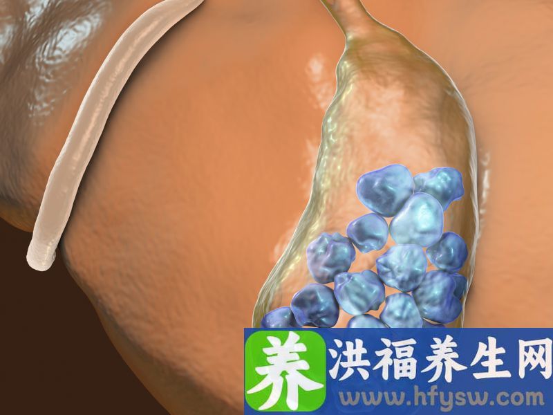 肾结石的饮食疗法