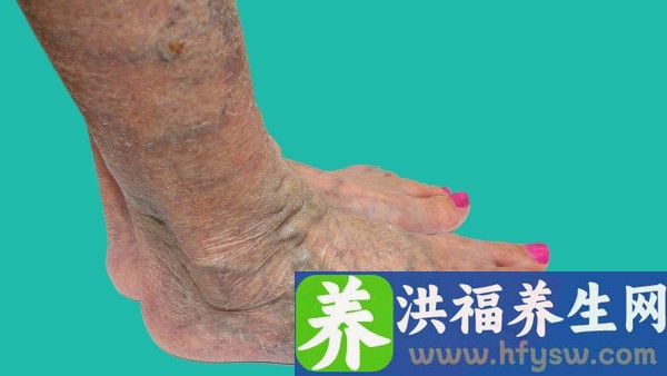 2型糖尿病馒头餐血糖