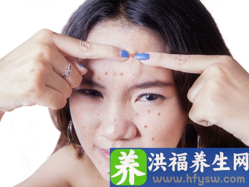 用手挤痘会留下痘坑吗 痘坑治愈期限是多长时间？