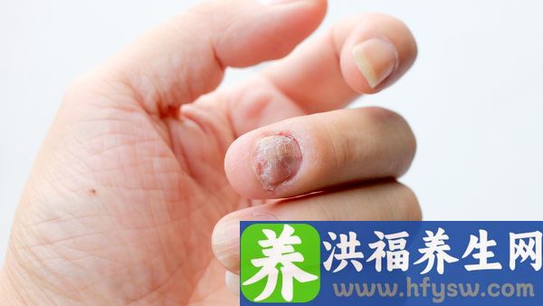 真菌感染的症状