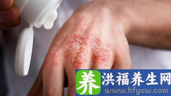 银屑灵颗粒对于牛皮癣的效果好吗 银屑灵颗粒是抗病毒的药吗