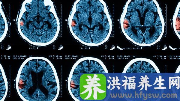 结核性脑膜炎一起吃饭传染吗能传染吗