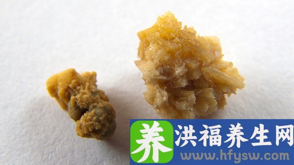 患先天性梅毒的症状是什么?梅毒会不会遗传