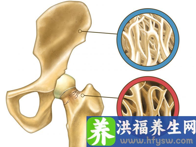 人到中年，多吃这5种食物，预防骨质疏松