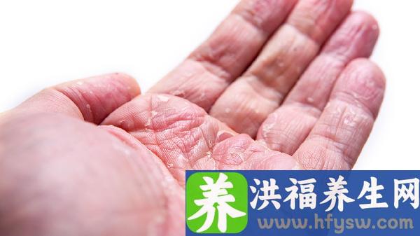 春季嘴唇干裂脱皮的原因是什么