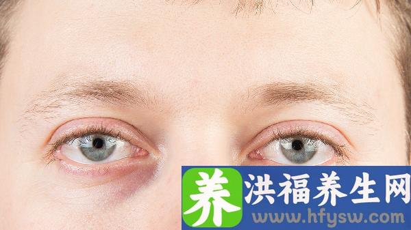 做眼袋手术后需要多长时间才能恢复