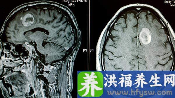重型颅脑损伤颅骨未修复应怎么护理