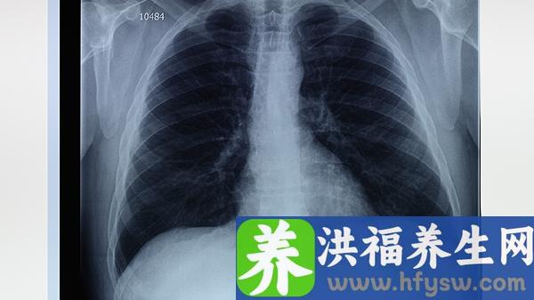 白肺病是什么病是癌症吗能活多久