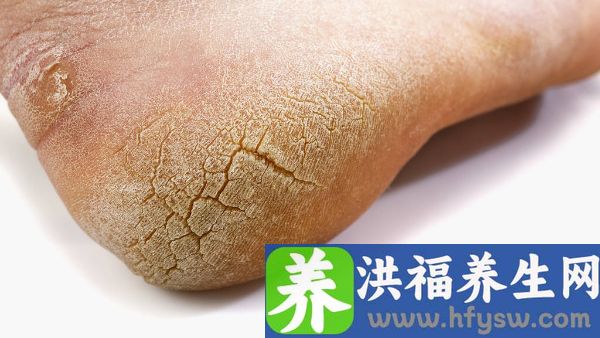 产后脚后跟痛的主要原因
