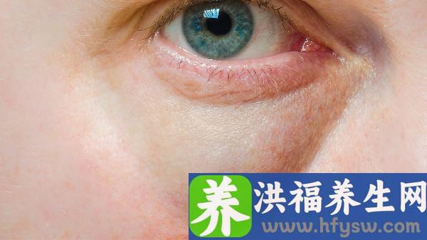 佩戴角膜塑形镜眼干怎么办