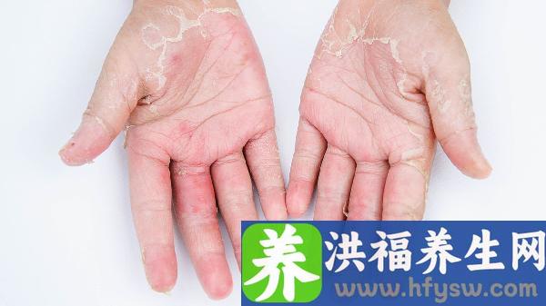 春天嘴唇干裂脱皮是什么原因
