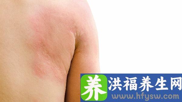 手上汗疱疹是什么样的