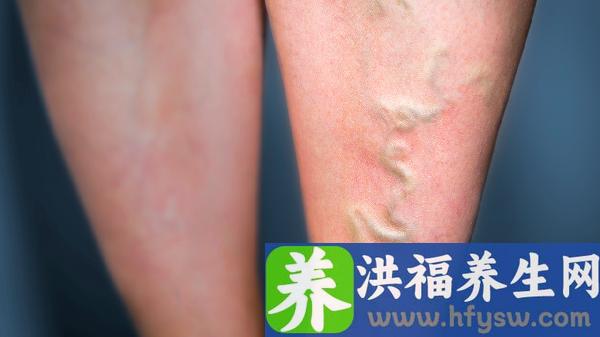 水肿怎么消肿比较好效果快
