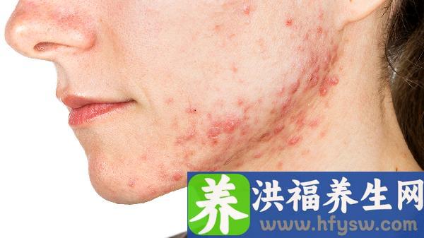 手脚汗疱疹是什么引起的