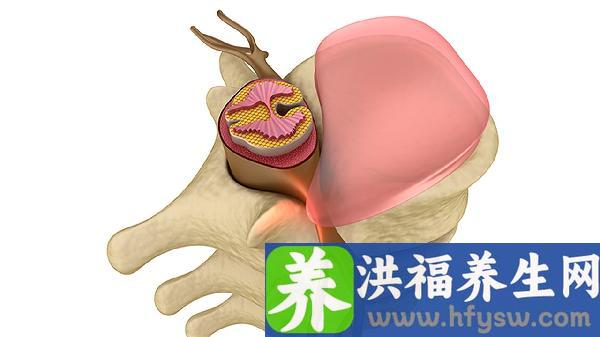 梨状肌压迫坐骨神经痛怎么办