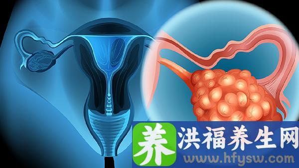 子宫颈癌最常见的症状有哪些
