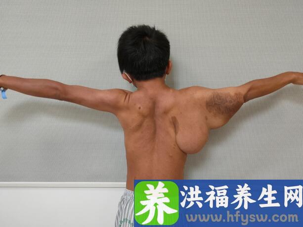 男子“肩”负巨大“肉球”30年，医生高难度手术解决棘手难题