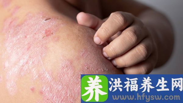 红斑狼疮手脚水肿怎么治疗
