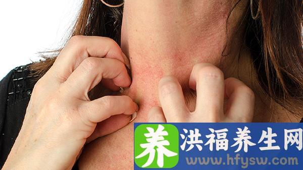 汗疱疹的临床表现