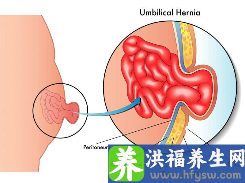 脐疝的保健护理