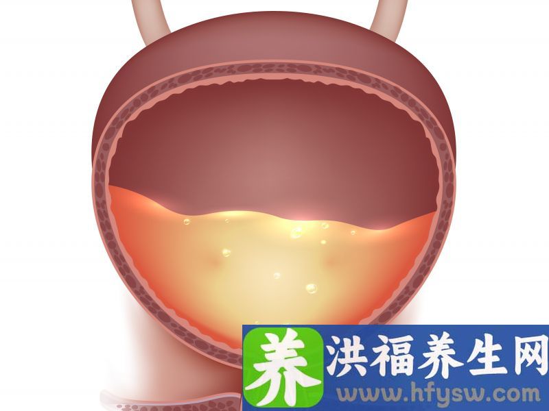膀胱结石症状