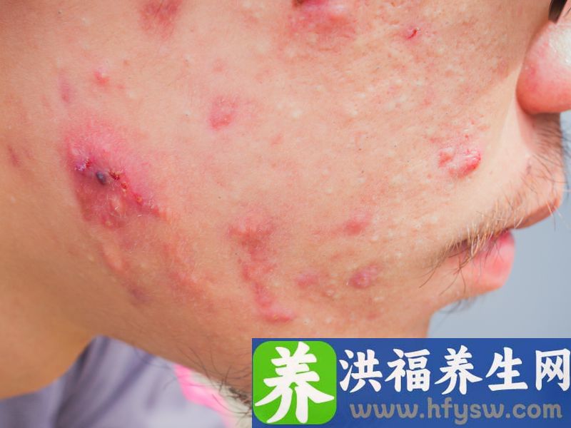 玫瑰痤疮的症状有哪些？激光治疗玫瑰痤疮好不好