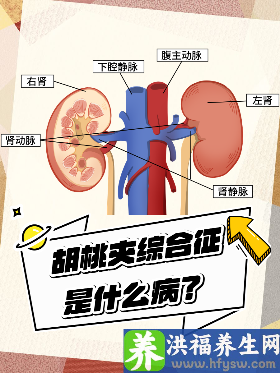 胡桃夹综合征是什么病？病因症状全解析