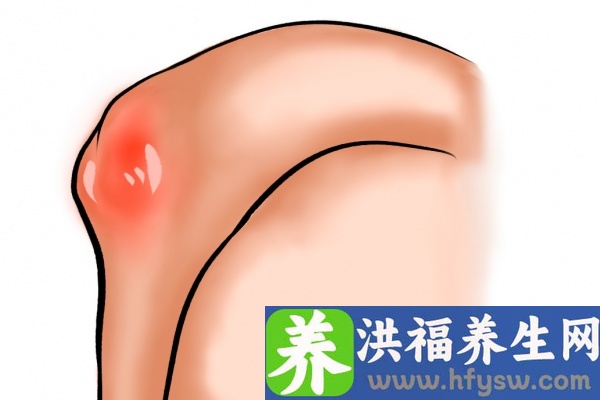 痛风可以吃板栗吗