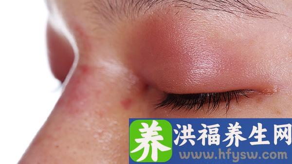 红斑狼疮是什么病会传染吗