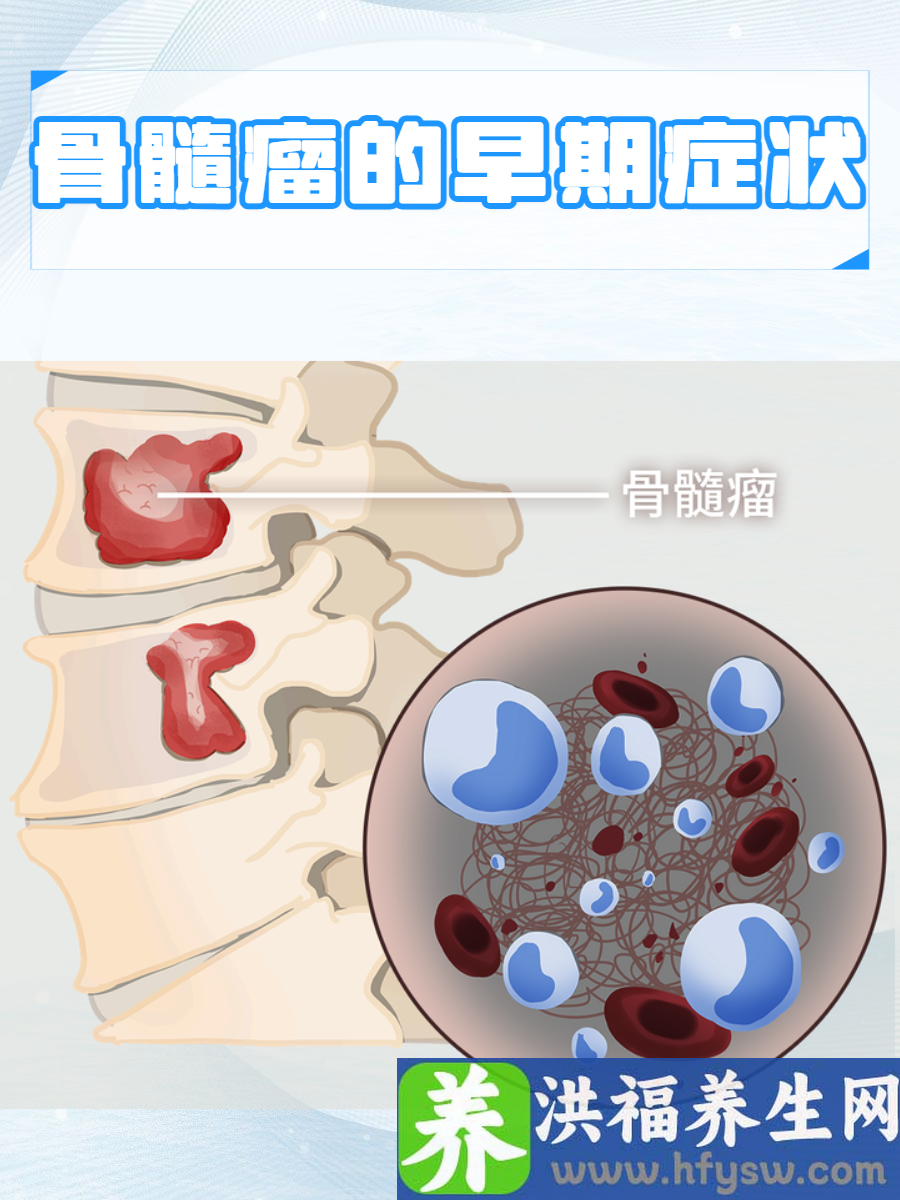 骨髓瘤的早期症状有哪些？全面认识骨髓瘤