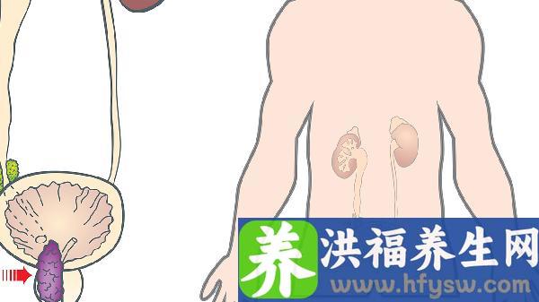 肾结石微创手术后可以喝酒吗