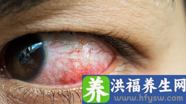 春季结膜炎1-2周恢复指南：轻症无需用药，重症对症治疗