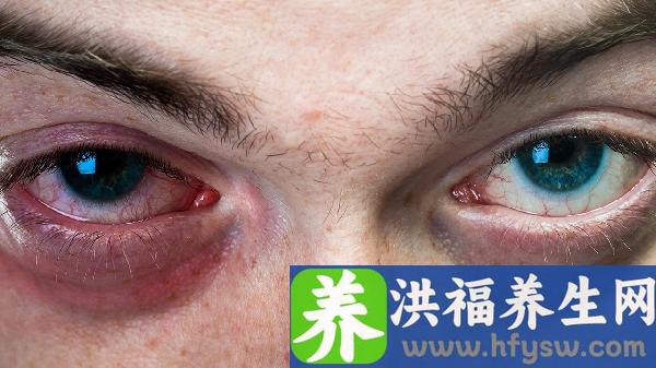 眼睑下到底是卧蚕还是眼袋