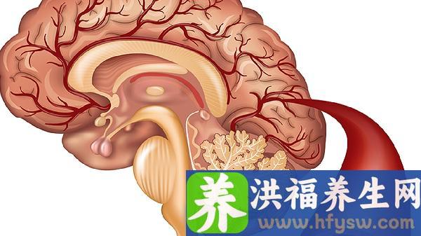 什么是脑梗死大血管堵死