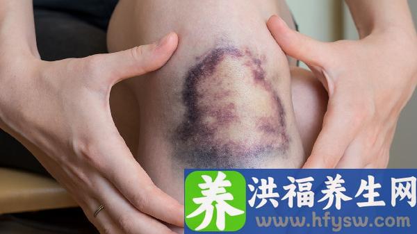 创伤性硬脑膜外出血严重吗