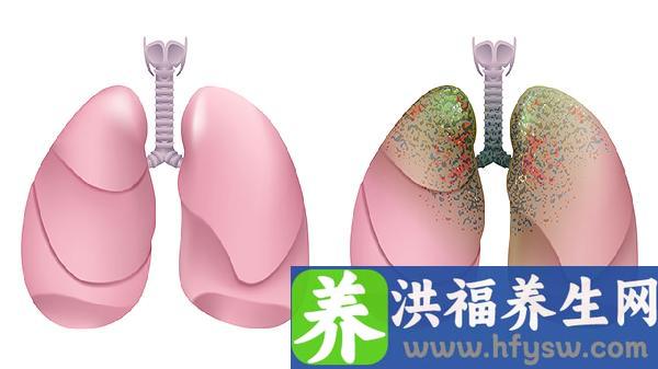 肾上腺肿瘤做什么检查能确诊出来