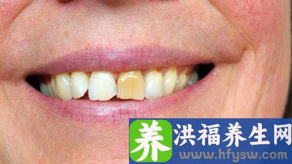老年人牙齿磨损严重有什么修复方法