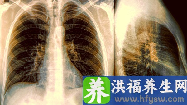 肺热吃什么药好 清肺热羚羊清肺丸效果好吗